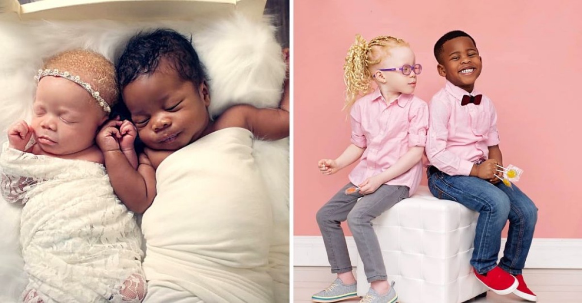 Gemelos Nacieron Con Distinto Color De Piel. Diferentes Por Fuera, Pero
