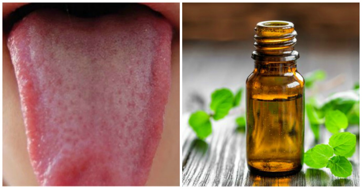 Remedio Casero Para Limpiar La Lengua Amarilla