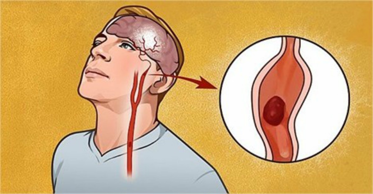 7 Síntomas Que Te Advierten Sobre Un Accidente Cerebrovascular Via Ritmo 7 Síntomas Que Te Advierten Sobre Un Accidente Cerebrovascular Via Ritmo